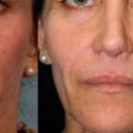 What are Restylane Injections and How Can They Help You Look Younger?