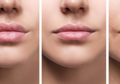 Which Filler is Best for Lips? A Comprehensive Guide