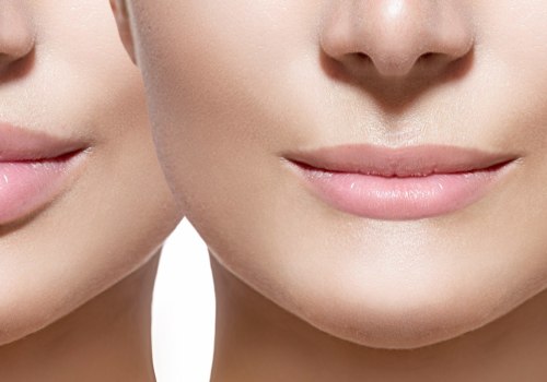 Which Lip Filler is Better: Juvederm or Restylane?